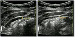 A Deep Learning Localization Method for Measuring Abdominal Muscle Dimensions in Ultrasound Images
