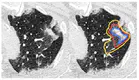 A Soft Labeling Approach to Develop Automated Algorithms that Incorporate Uncertainty in Pulmonary Opacification on Chest CT using COVID-19 Pneumonia